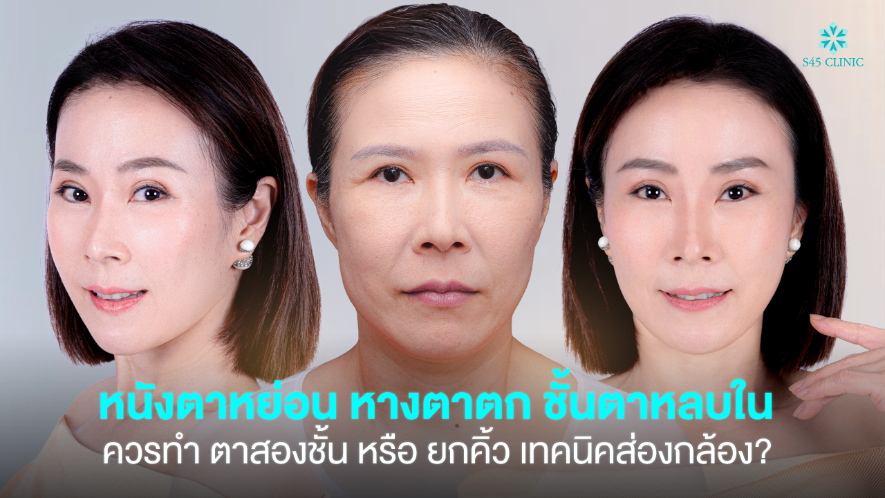 endoscopic brow lift assessment s45 clinic