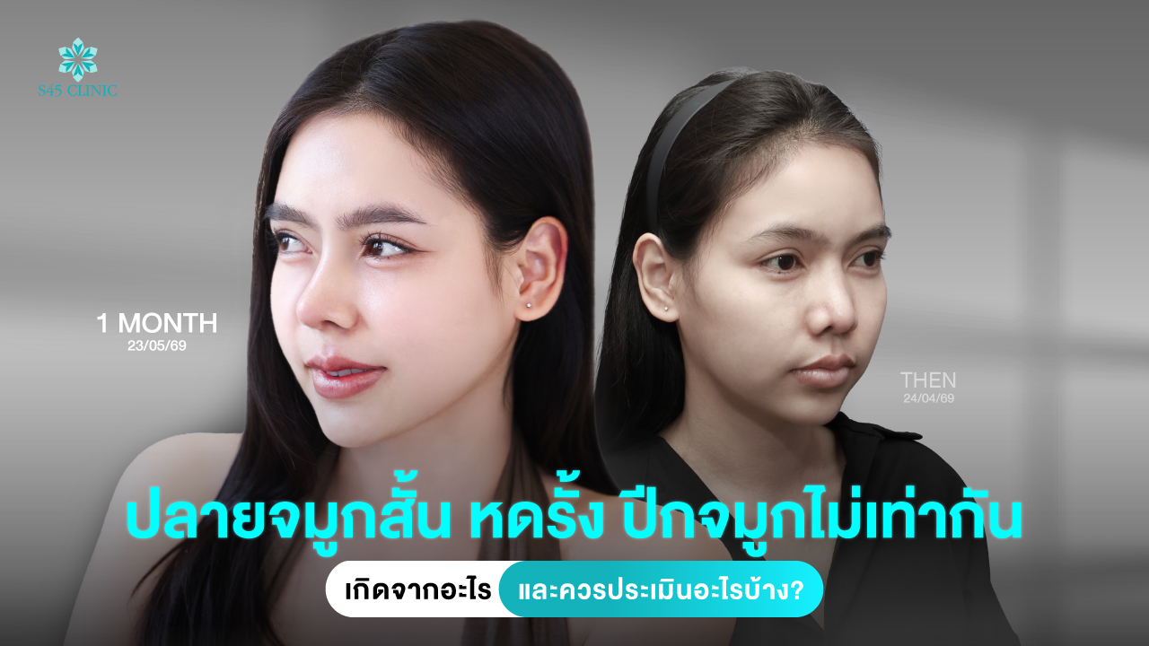 httpss45clinic comshort nose tip alar structure s45clinic