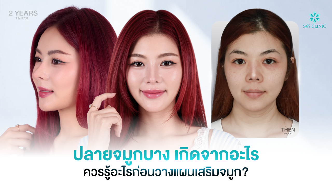 thin nose tip open rhinoplasty s45clinic