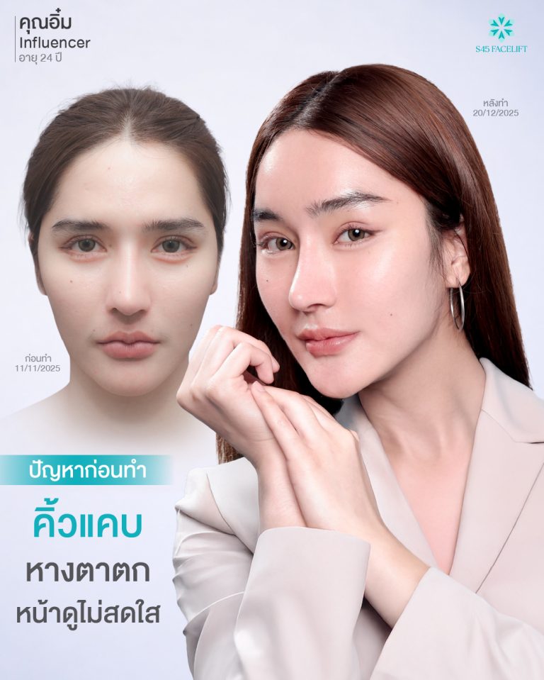 หนังตาหย่อน หางตาตก ชั้นตาหลบใน เกิดจากอะไรได้บ้าง? 3 คิ้วแคบ ห่างตาตก
