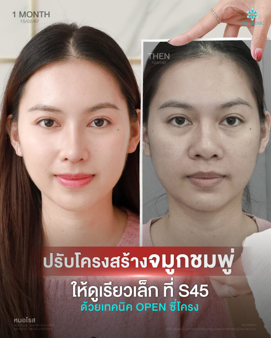 จมูกชมพู่คืออะไร? เสริมจมูก Open ปรับปลายได้ไหม 2 จมูกชมพู่ ปลสยใหญ่