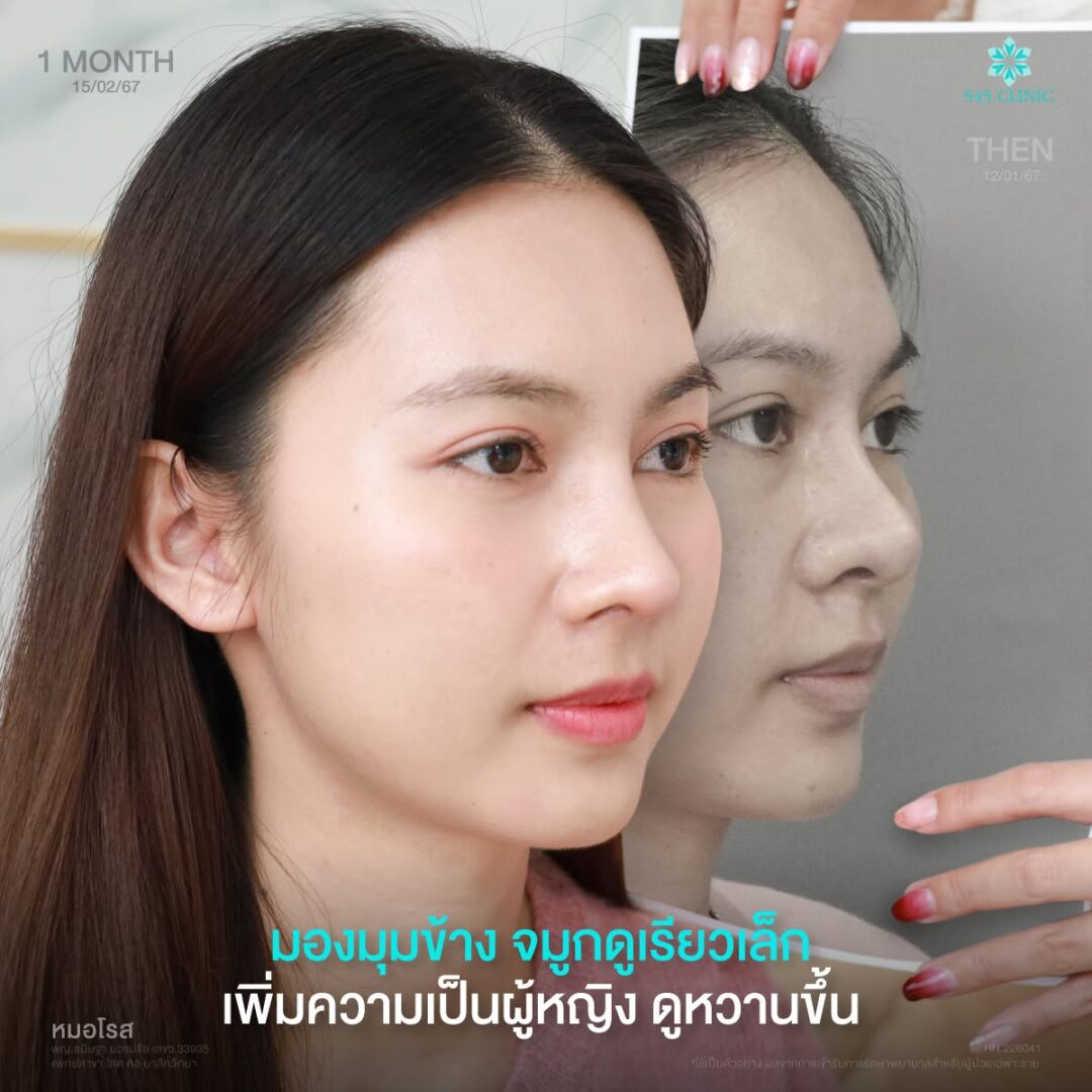 จมูกชมพู่คืออะไร? เสริมจมูก Open ปรับปลายได้ไหม 3 จมูกชมพู่ หน้าหวานละมุน