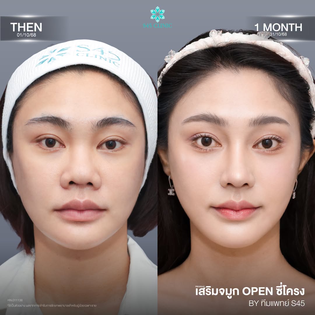 จมูกสั้น หดรั้ง