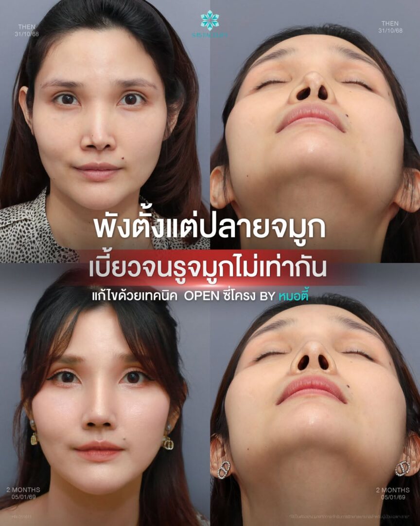 จมูกเอียง รูจมูกไม่เท่ากัน
