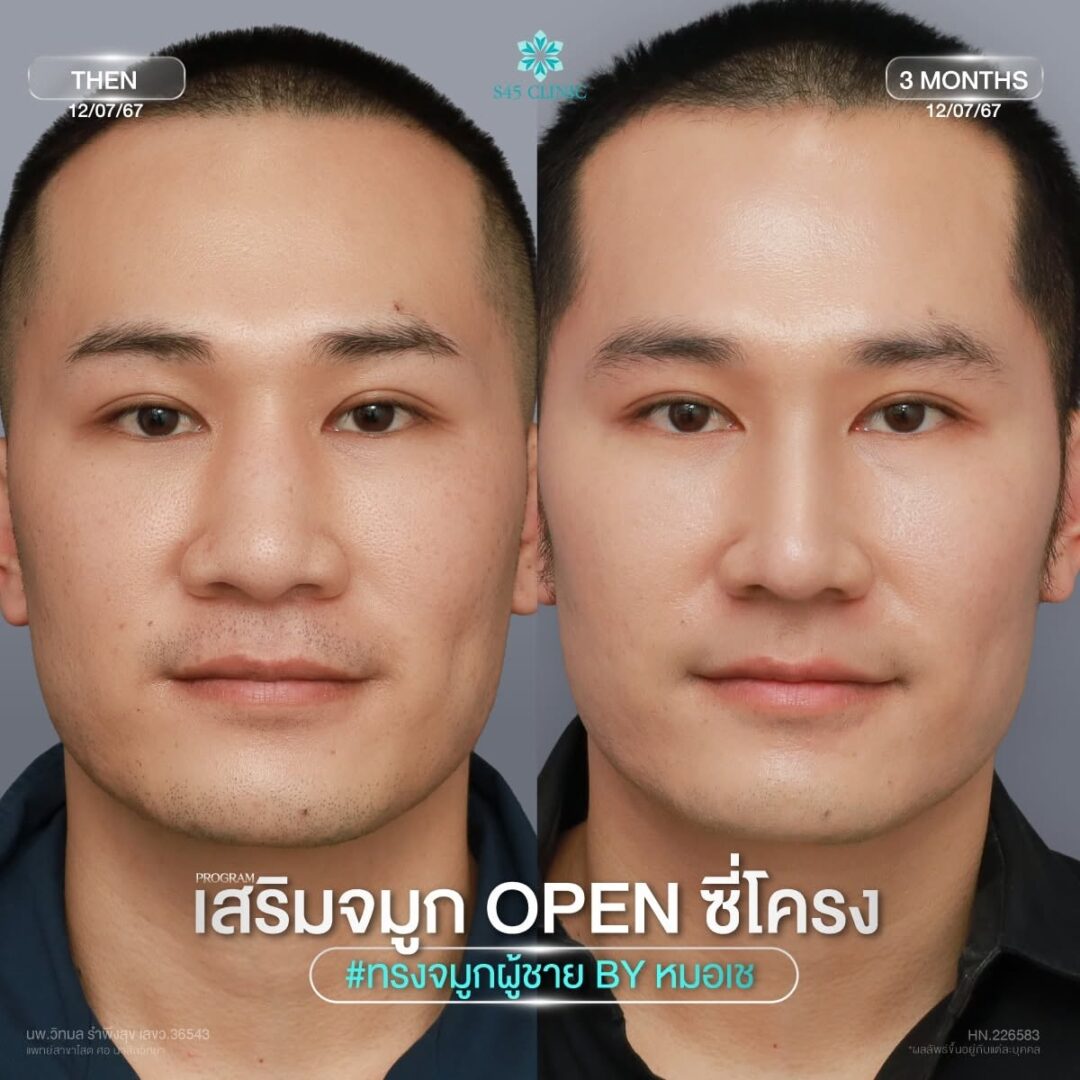 จมููกมีฮั้มพ์