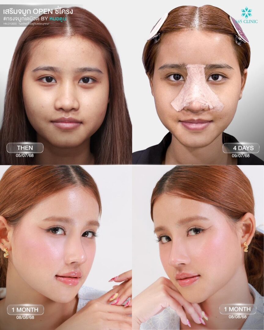 ดั้งแหมบคืออะไร? สันจมูกต่ำเสริมจมูก Open ได้ไหม 2 ดั้งแหมบ S45 Clinic
