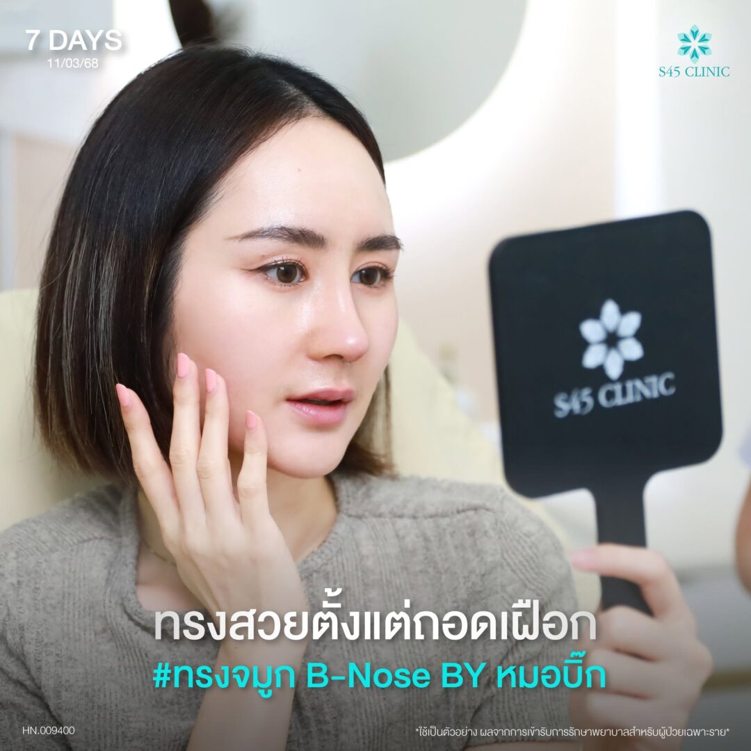ถอดเฝือกจมูก 7 วัน