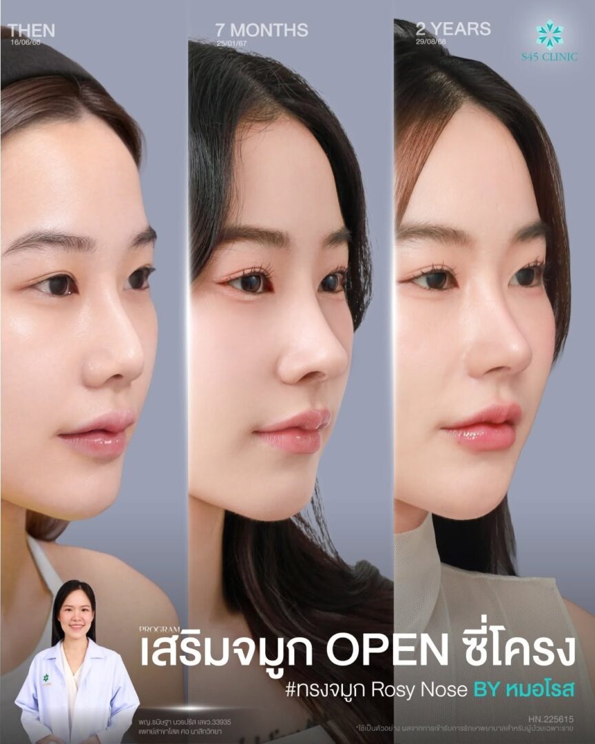 ทรงจมูก เทคนิค open