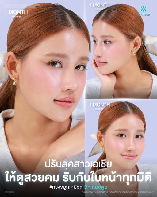 ดั้งแหมบคืออะไร? สันจมูกต่ำเสริมจมูก Open ได้ไหม 3 ทรงจมูกเข้ากับใบหน้า