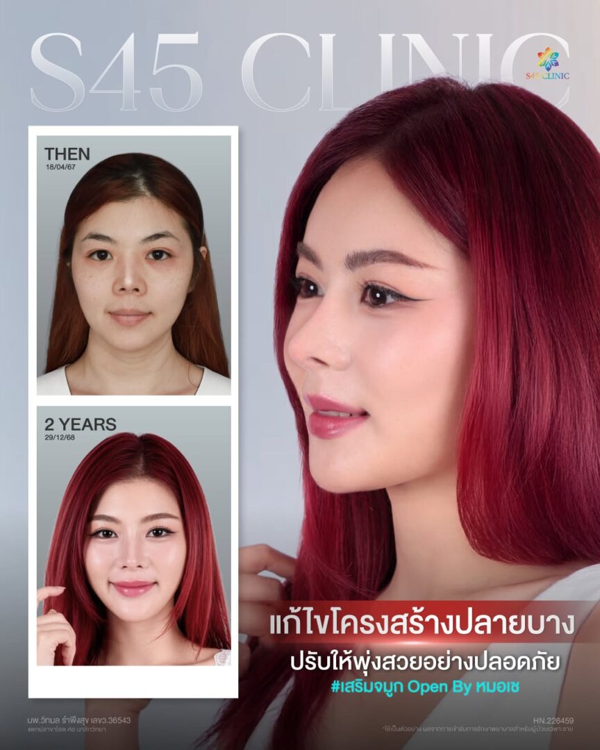 ปลายจมูกบาง