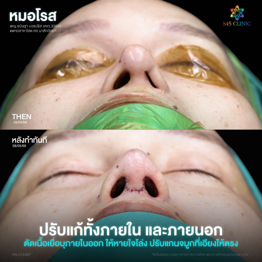 ปัญหาทรงจมูกซับซ้อน
