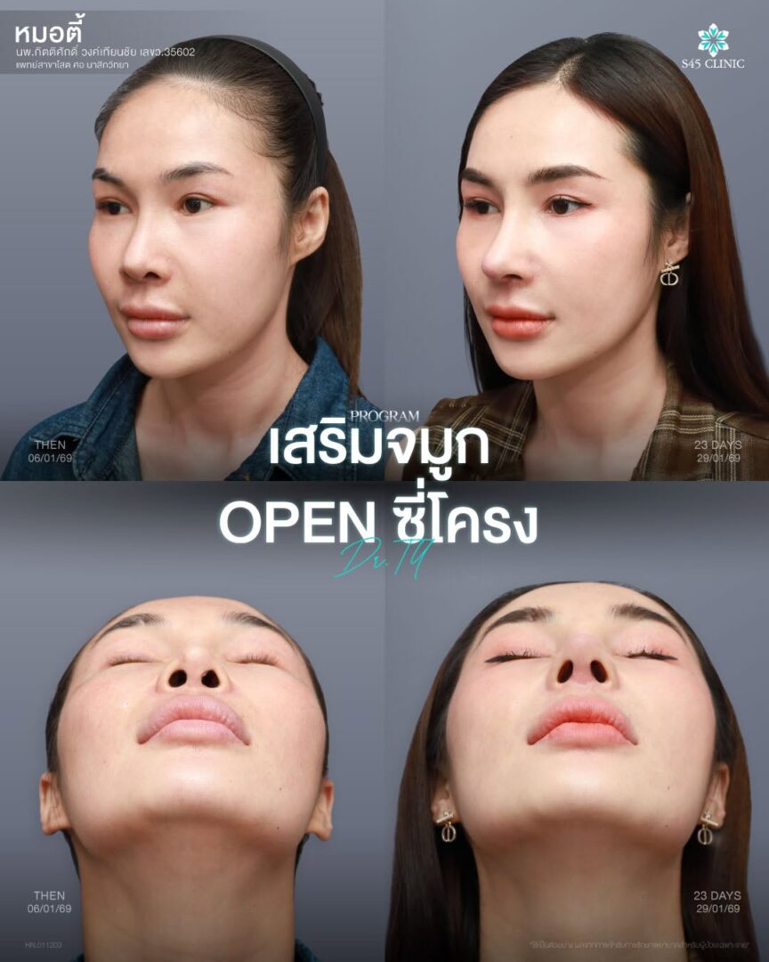 ปัญหาปลายจมูกบาง