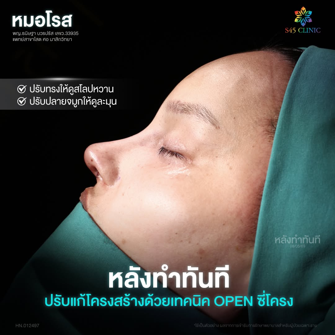 ผนังกั้นจมูกคด open