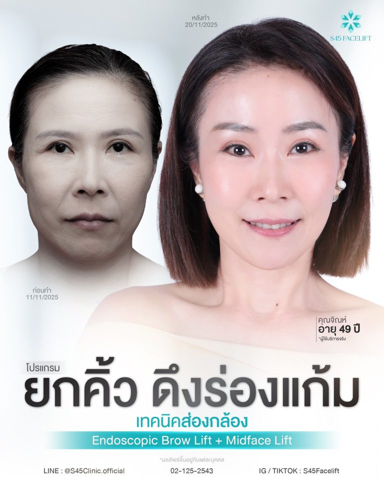 หนังตาหย่อน หางตาตก ชั้นตาหลบใน เกิดจากอะไรได้บ้าง? 2 ยกคิ้ว S45 Clinic