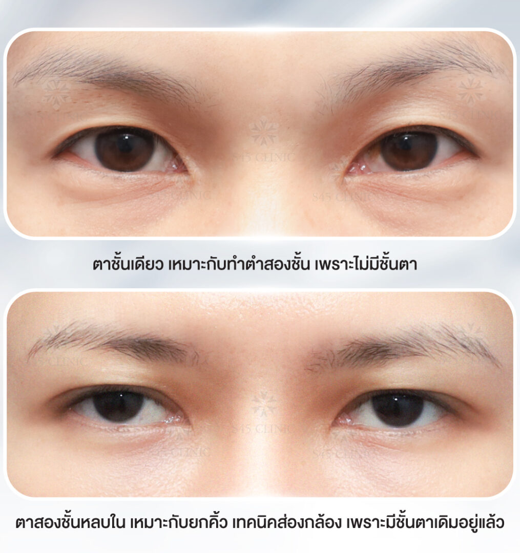 หนังตาหย่อน หางตาตก ชั้นตาหลบใน เกิดจากอะไรได้บ้าง? 6 ยกคิ้วเทคนิคส่องกล้อง ตาสองชั้นหลบใน