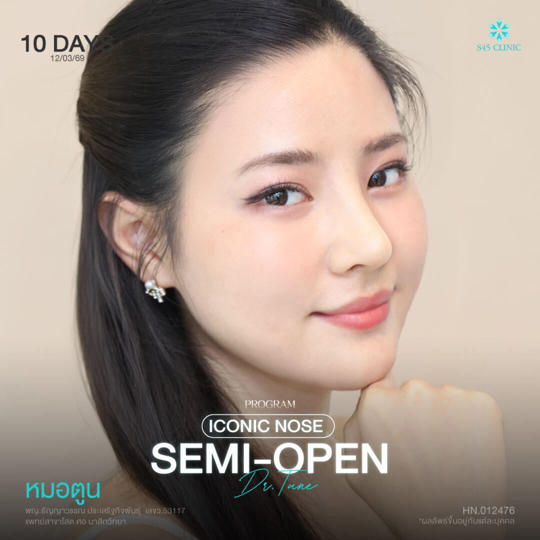 รองปลายจมูกคืออะไร? 3 วัสดุที่ใช้ในการเสริมจมูก Semi-Open 2 รองปลายเนื้อเหยื่อเที่ยม