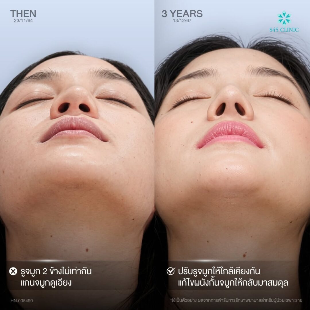 รูจมูกไม่เท่ากัน