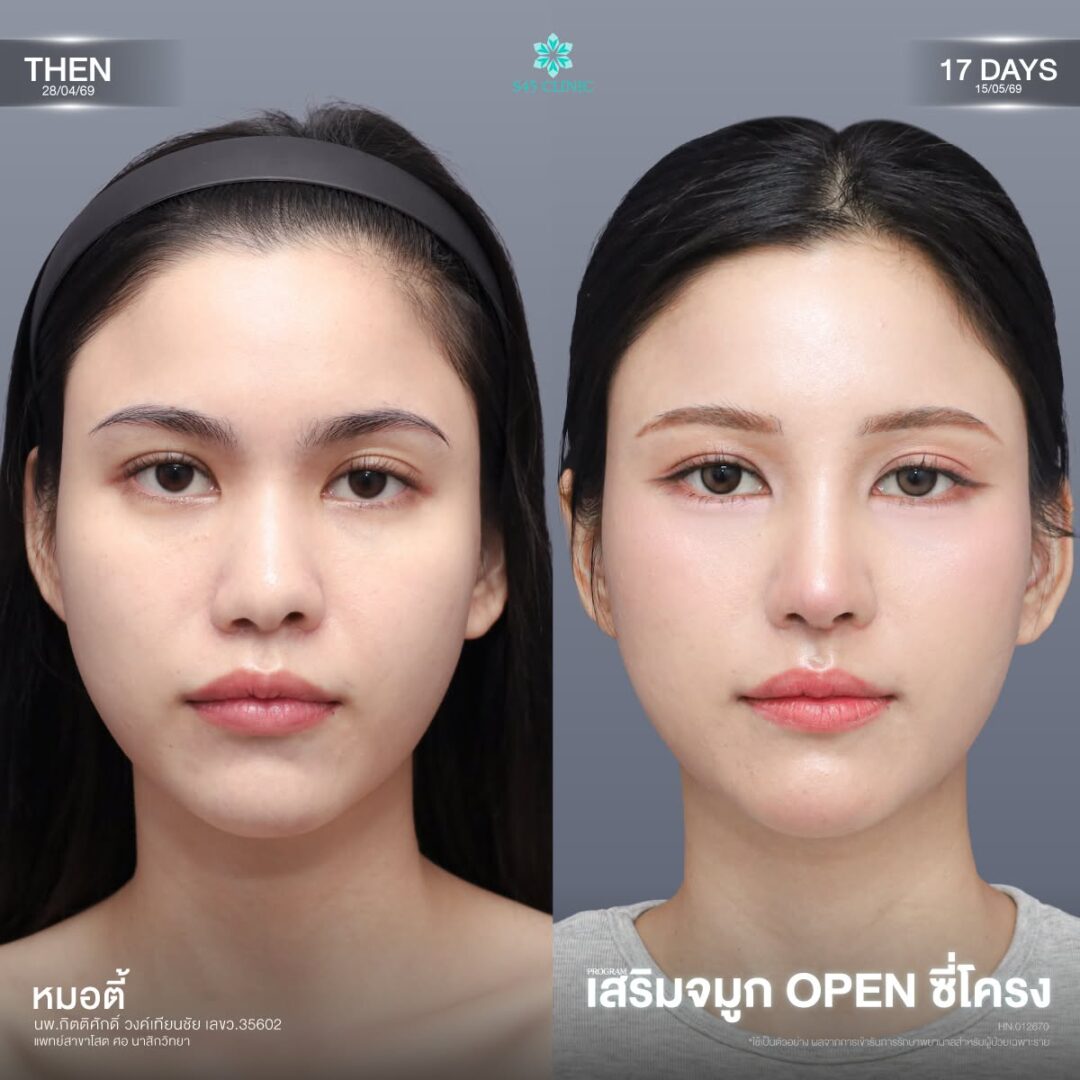 รูจมูกไม่เท่ากัน เสริมจมูก
