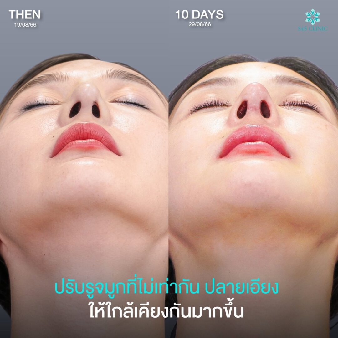 รูจมูกไม่เท่ากัน เสริมจมูก open