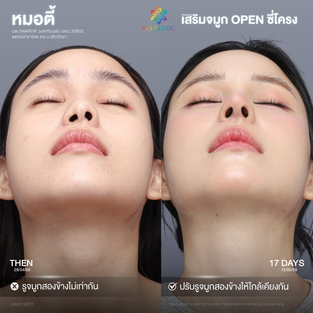 รูจมูกไม่เท่ากัน เสริมจมูกโอเพ่น
