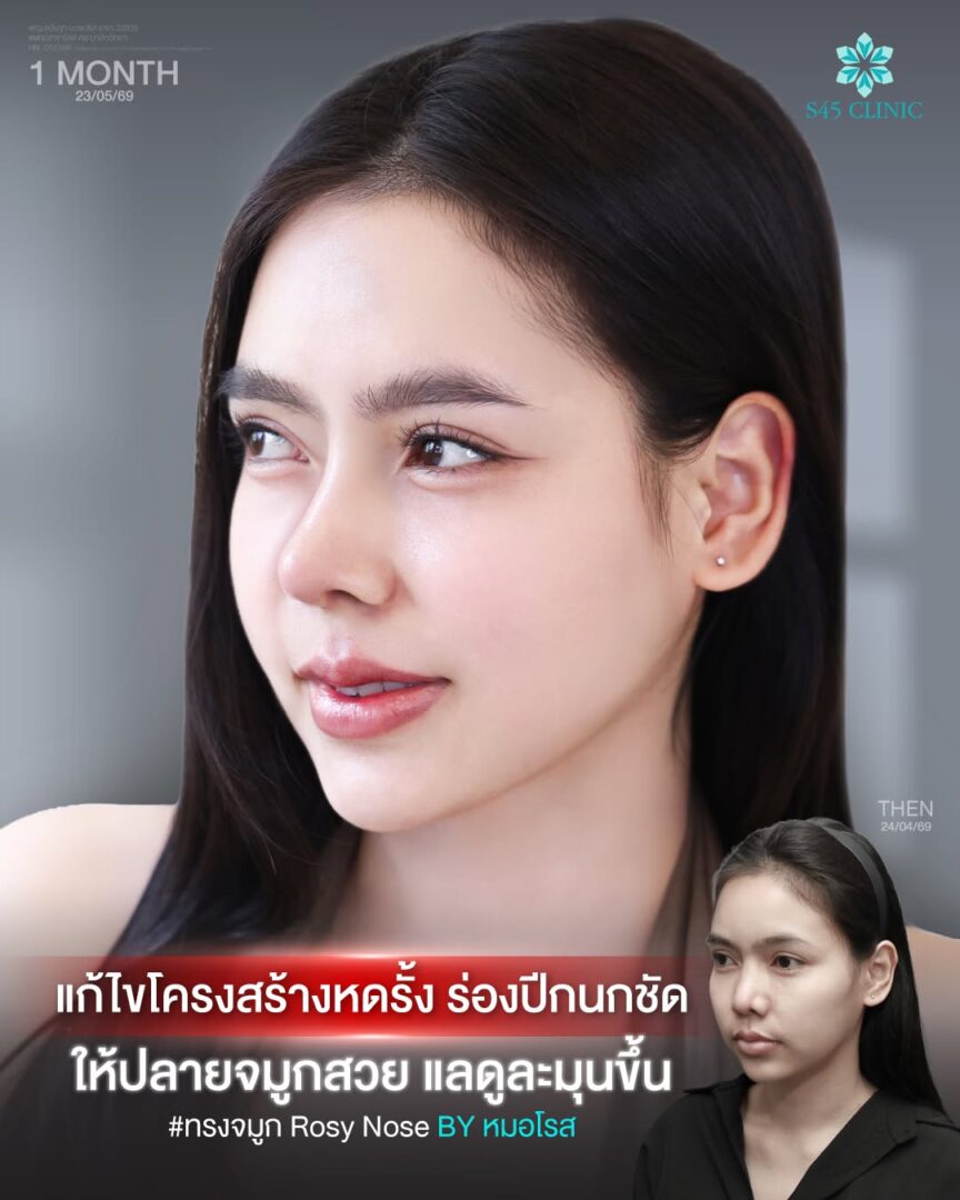 ร่องปีกจมูกชัด