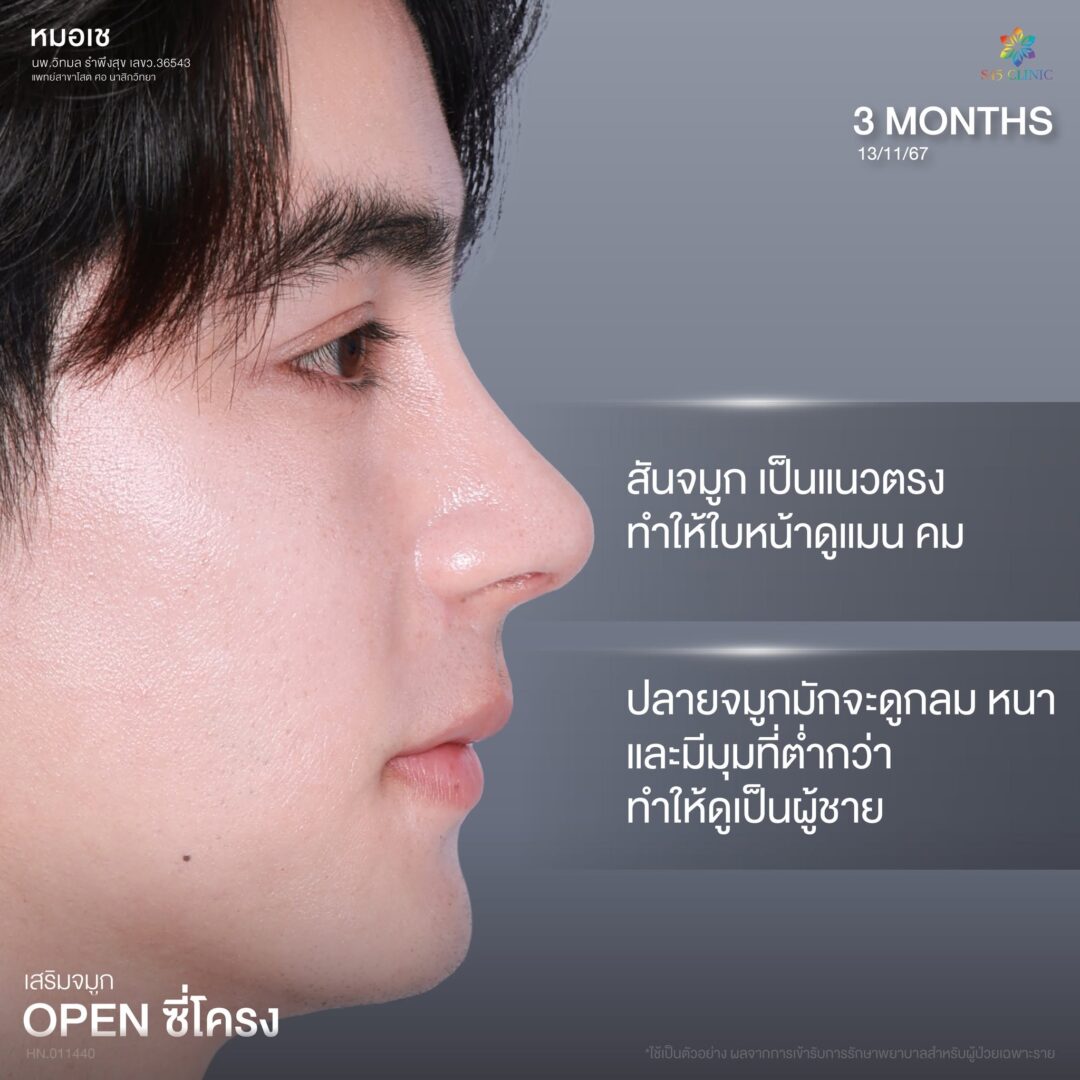 ทรงจมูกผู้ชายกับผู้หญิงต่างกันอย่างไร เลือกแบบไหนให้เหมาะกับคุณ? 4 ลักษณะทรงจมูกผู้ชาย