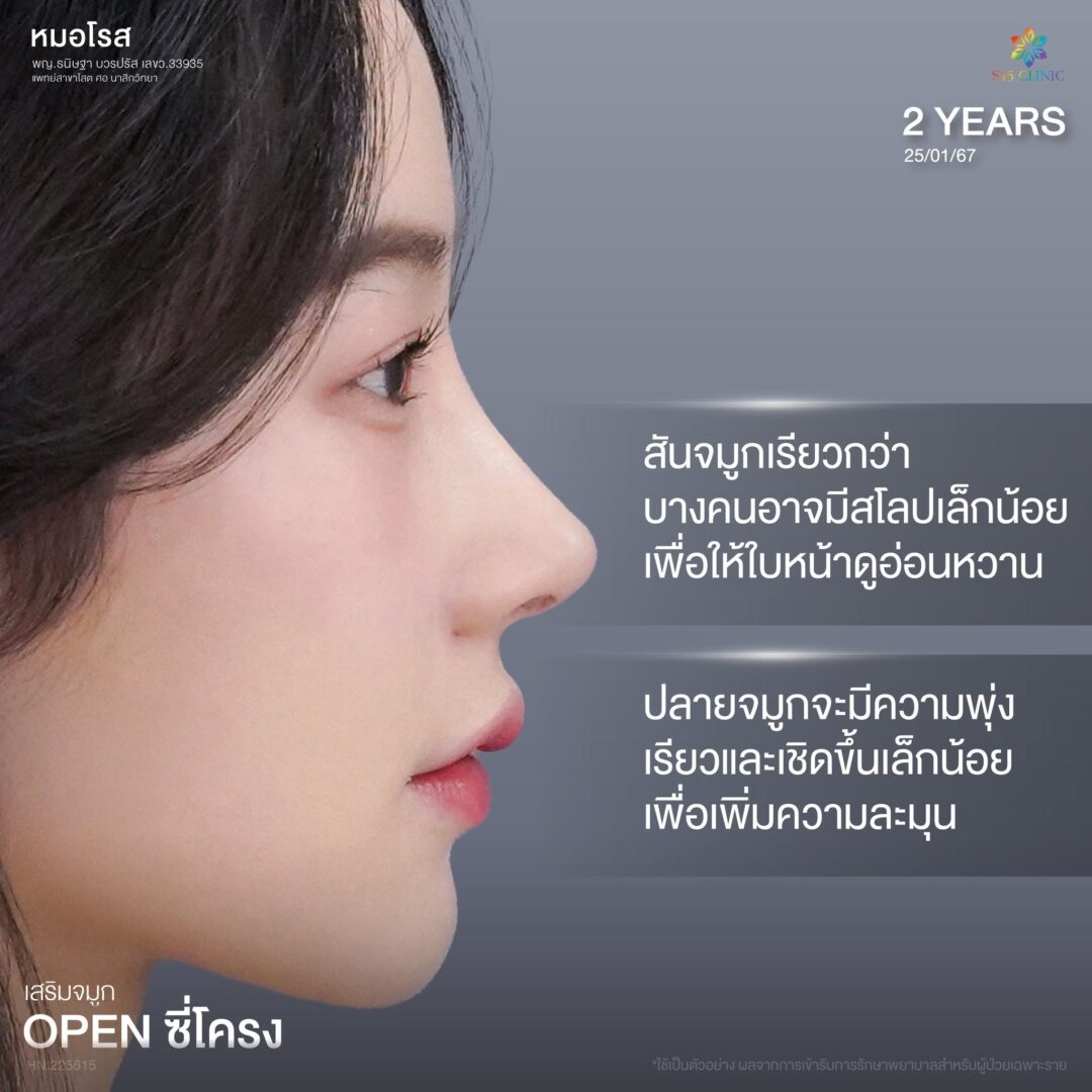 ทรงจมูกผู้ชายกับผู้หญิงต่างกันอย่างไร เลือกแบบไหนให้เหมาะกับคุณ? 5 ลักษณะทรงจมูกผู้หญิง