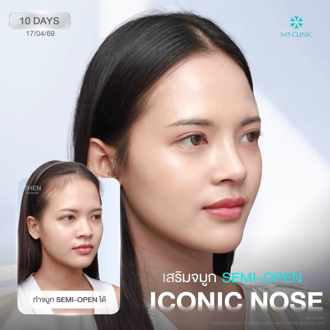 เสริมจมูก s45 เทคนิค semi
