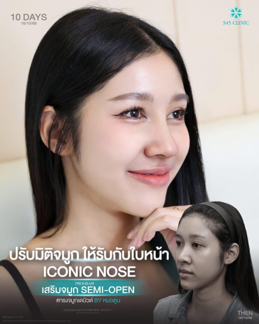 เสริมจมูก ที่ S45 Clinic