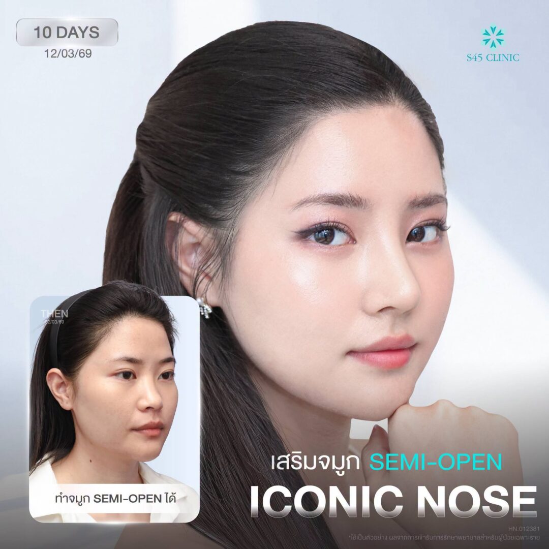 เสริมจมูกธรรมชาติ เทคนิค semi
