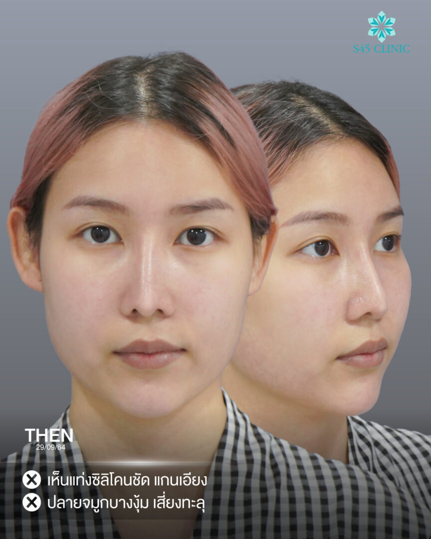 เสริมจมูกปลายบาง