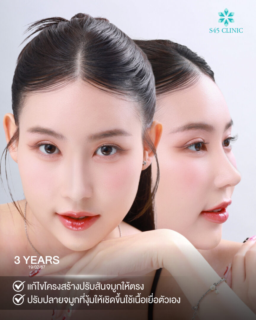 เสริมจมูกปลายบาง ทรงสวย