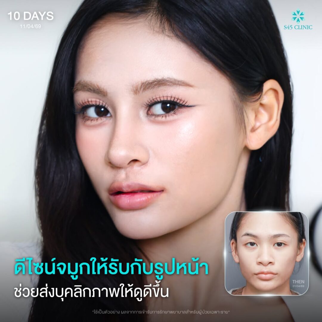 เสริมจมูกปลายพุ่ง