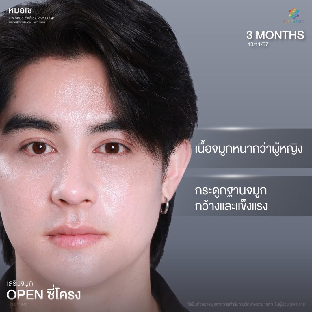 ทรงจมูกผู้ชายกับผู้หญิงต่างกันอย่างไร เลือกแบบไหนให้เหมาะกับคุณ? 2 เสริมจมูกผู้ชาย