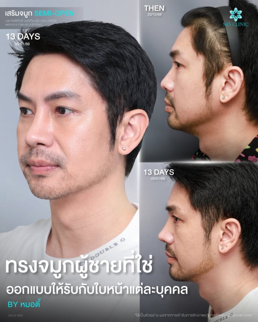 ทรงจมูกผู้ชายกับผู้หญิงต่างกันอย่างไร เลือกแบบไหนให้เหมาะกับคุณ? 6 เสริมจมูกผู้ชาย S45 Clinic