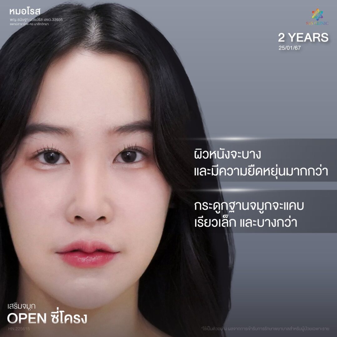 ทรงจมูกผู้ชายกับผู้หญิงต่างกันอย่างไร เลือกแบบไหนให้เหมาะกับคุณ? 3 เสริมจมูกผู้หญิง