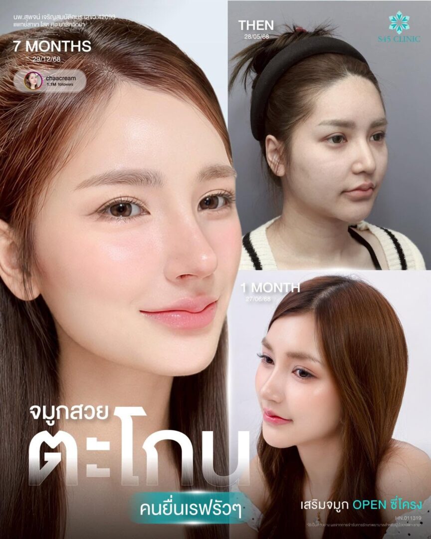 ทรงจมูกผู้ชายกับผู้หญิงต่างกันอย่างไร เลือกแบบไหนให้เหมาะกับคุณ? 7 เสริมจมูกผู้หญิง S45 Clinic