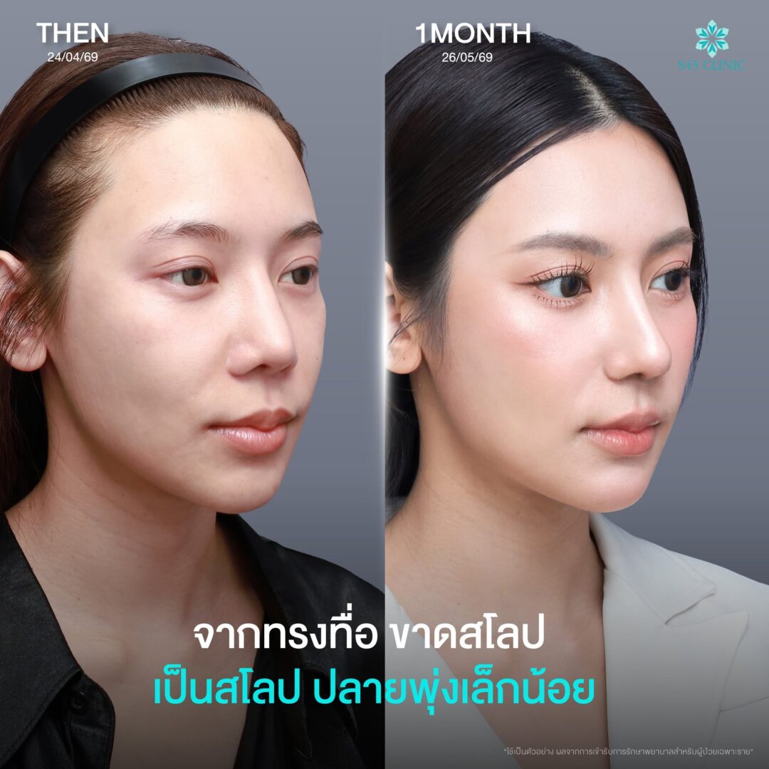 เสริมจมูกแก้ทรงจมูก