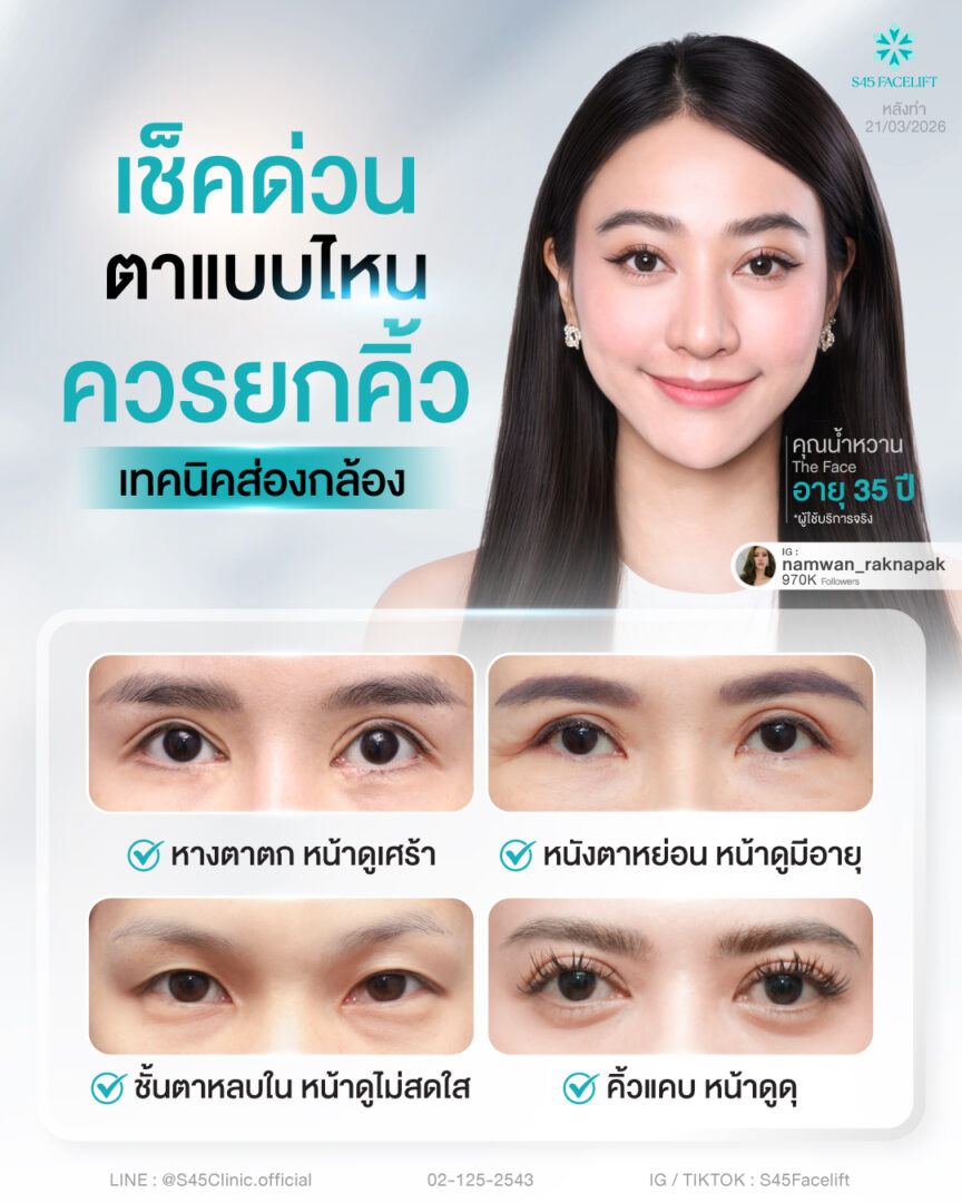 หนังตาหย่อน หางตาตก ชั้นตาหลบใน เกิดจากอะไรได้บ้าง? 4 ใครบ้างที่ควรยกคิ้ว