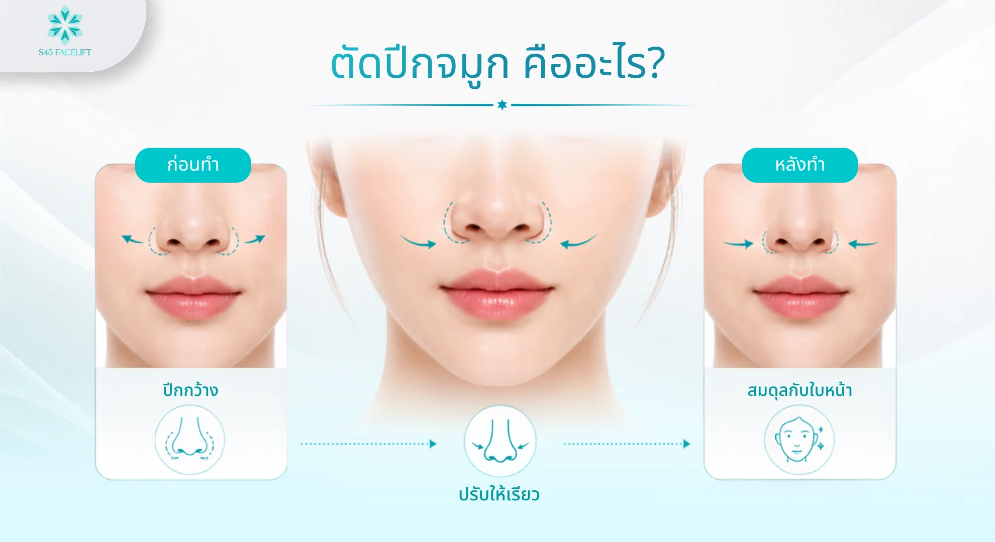 ตัดปีกจมูกที่ไหนดี คืออะไร