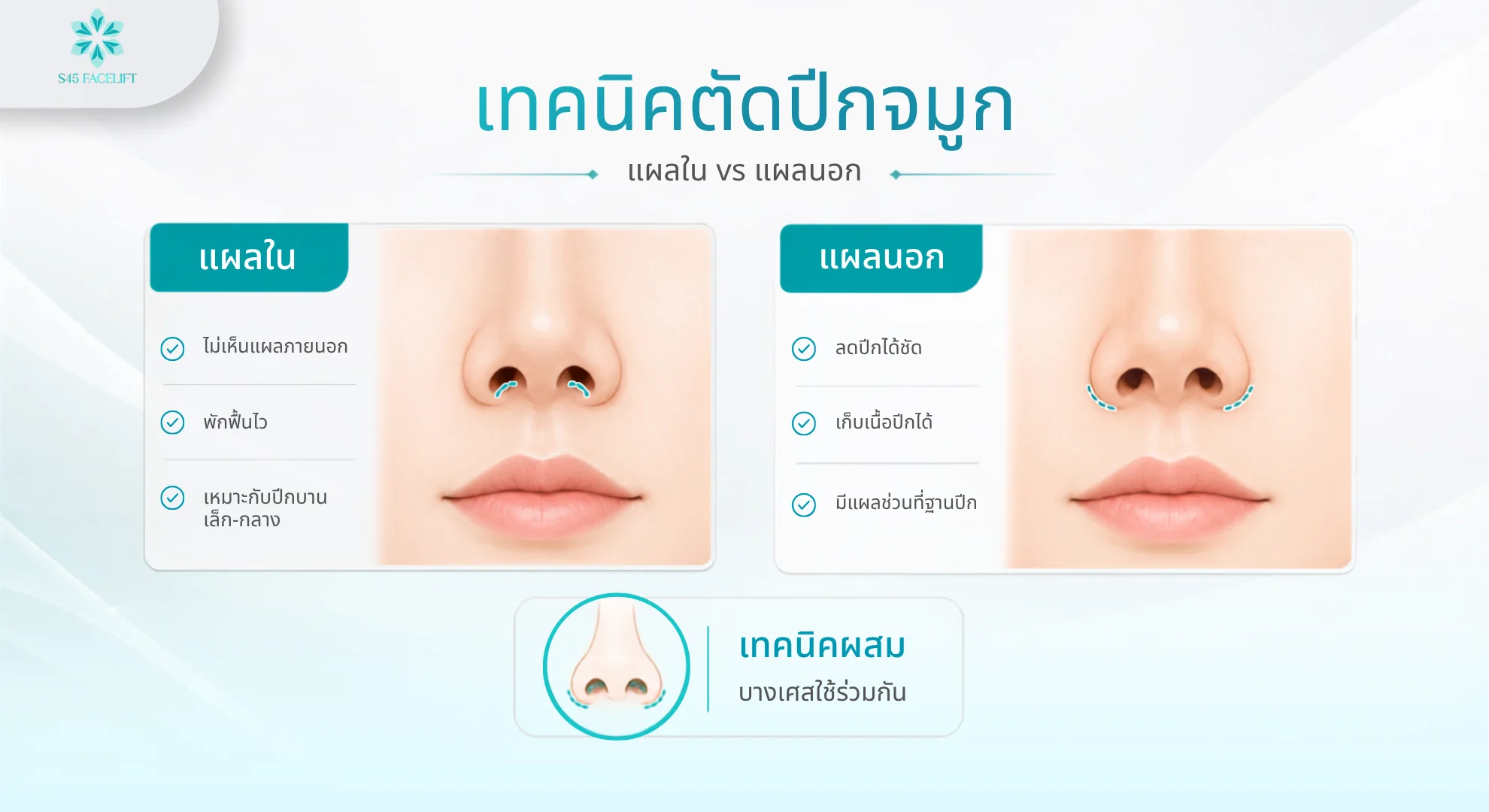 ตัดปีกจมูกที่ไหนดี เทคนิค