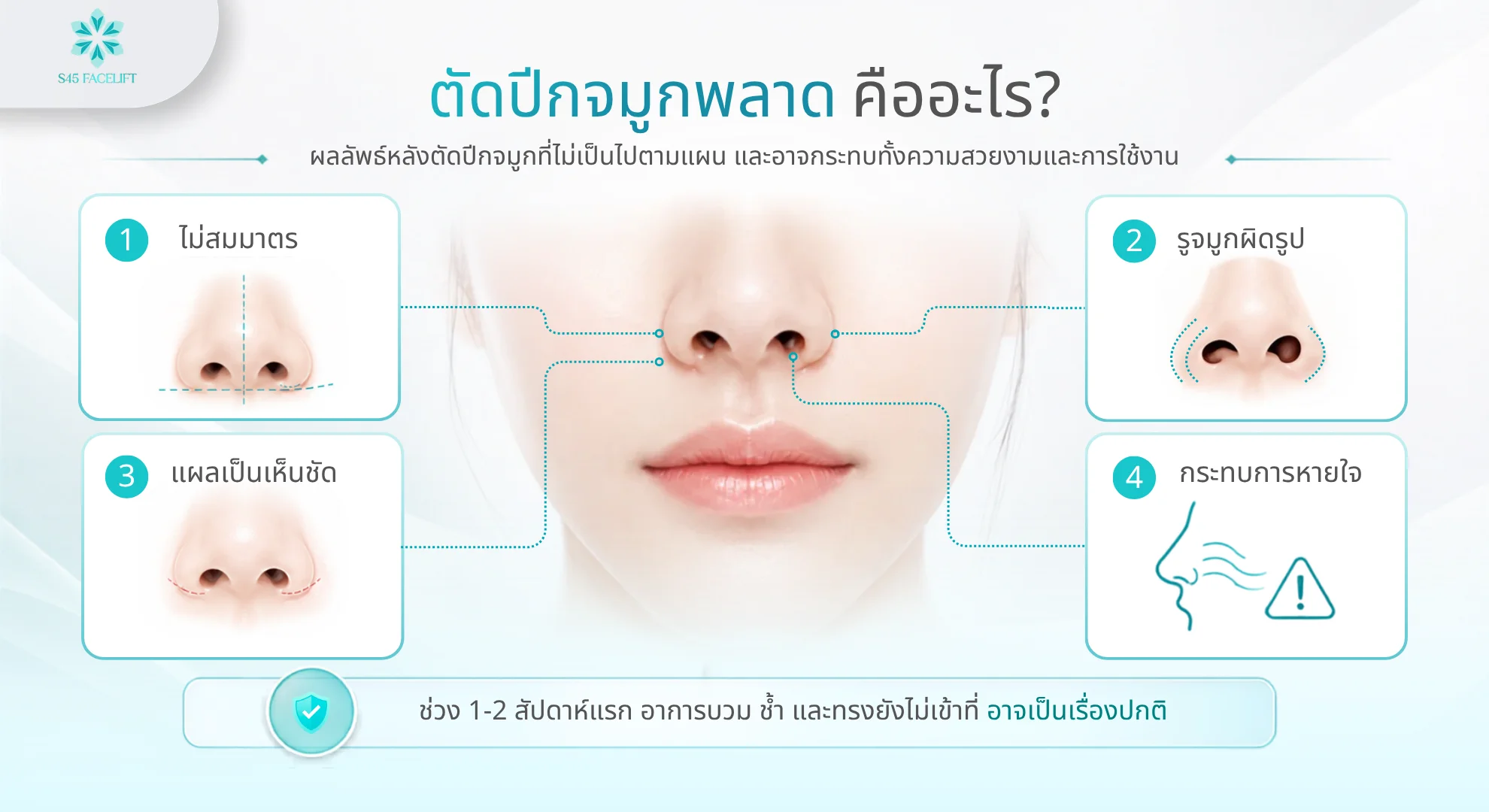 ตัดปีกจมูกพลาด คืออะไร