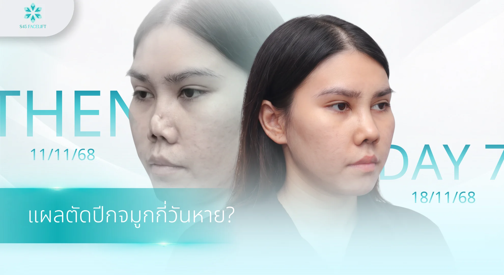 ตัดปีกจมูกพลาด แผลก่อน-หลัง