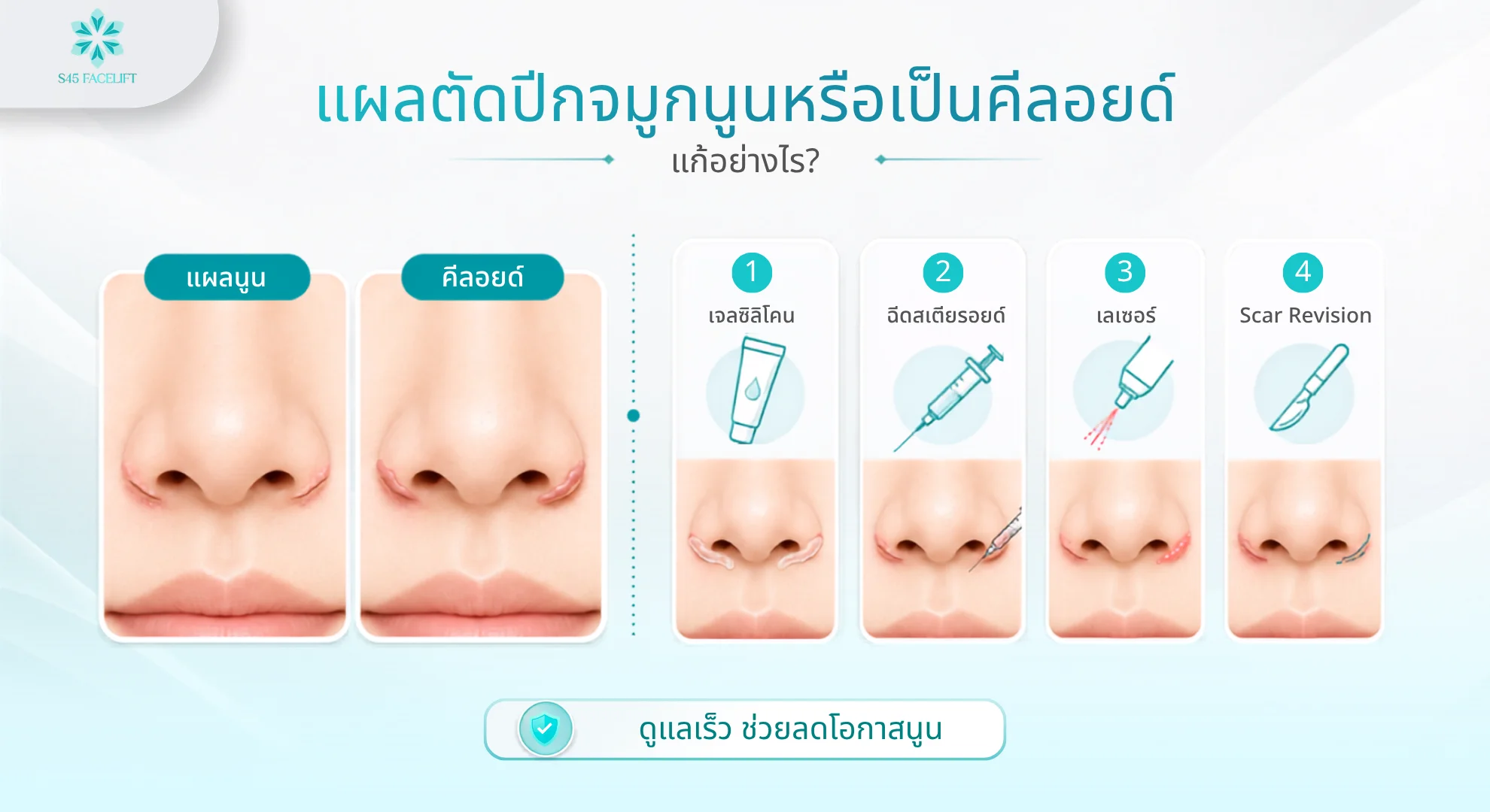 แผลตัดปีกจมูก แผลนูน-คีลอยด์