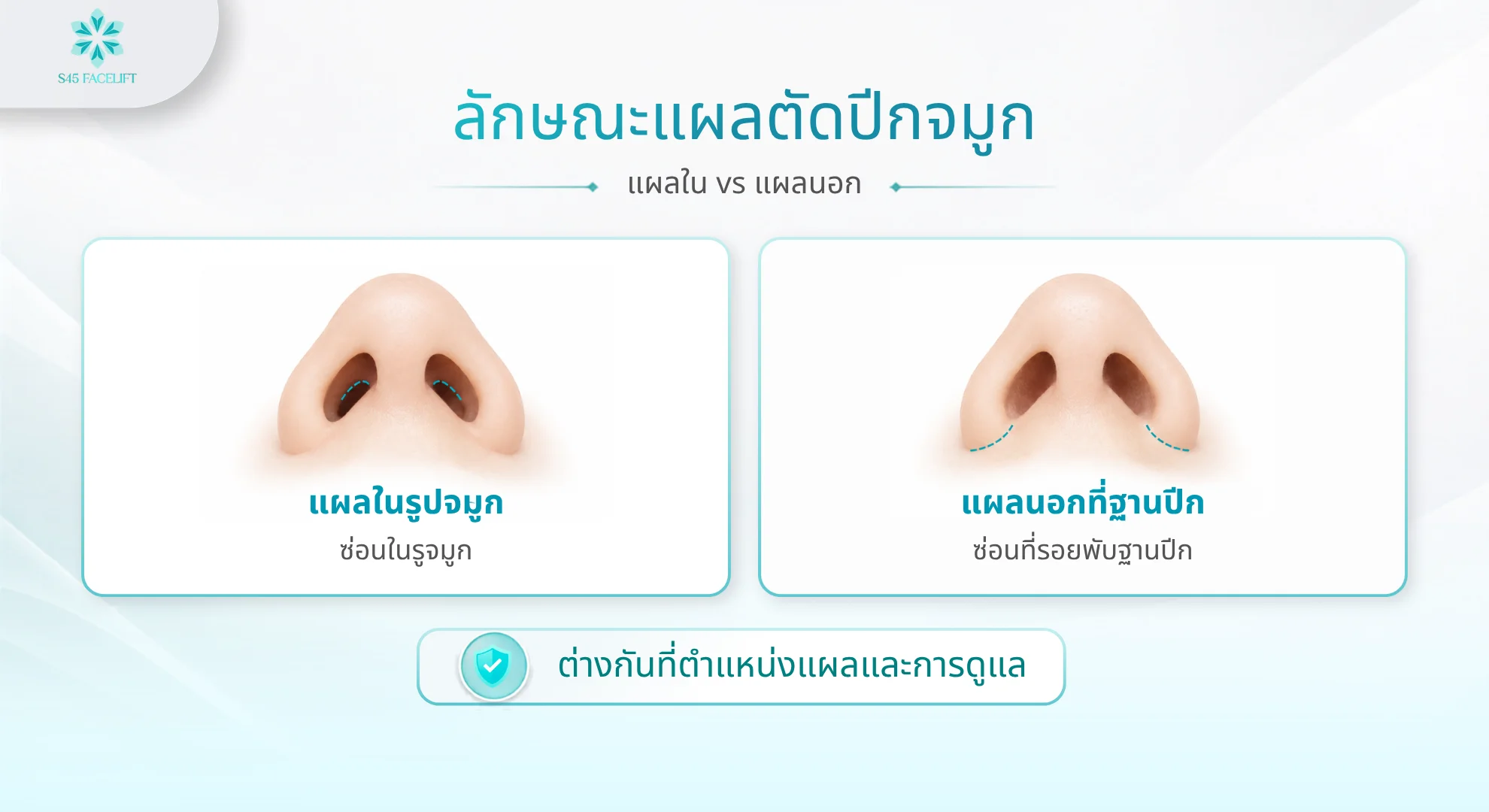 แผลตัดปีกจมูก แผลในเทียบแผลนอก