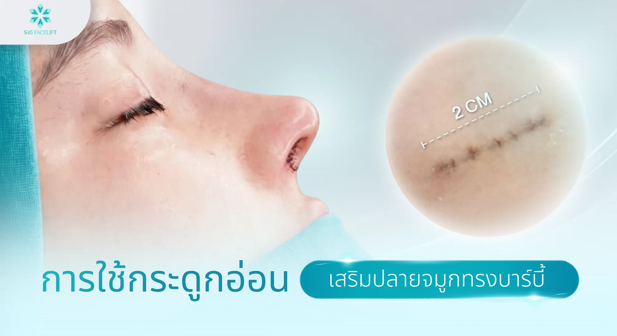 จมูกทรงบาร์บี้ เสริมปลายด้วยกระดูกอ่อน