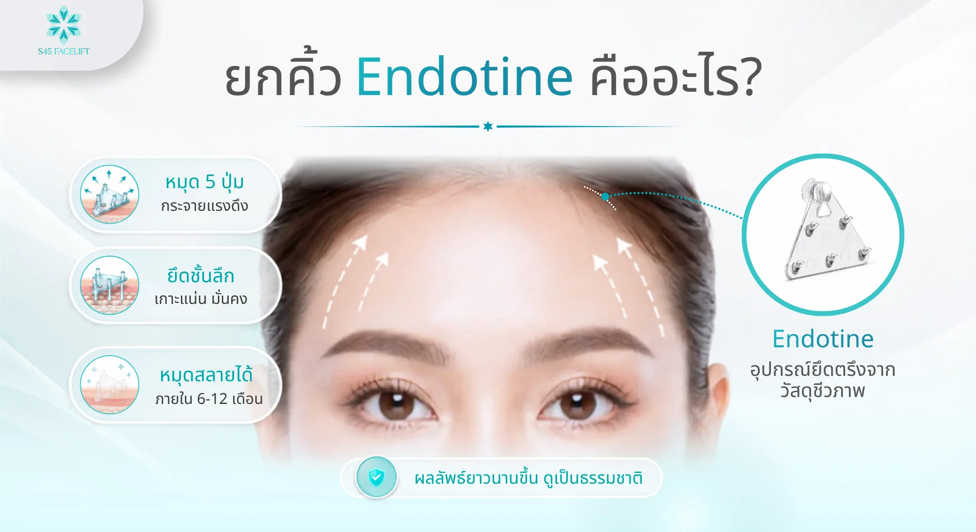 Endotine วัสดุยึดโครงสร้างยกคิ้วให้ผลยั่งยืน