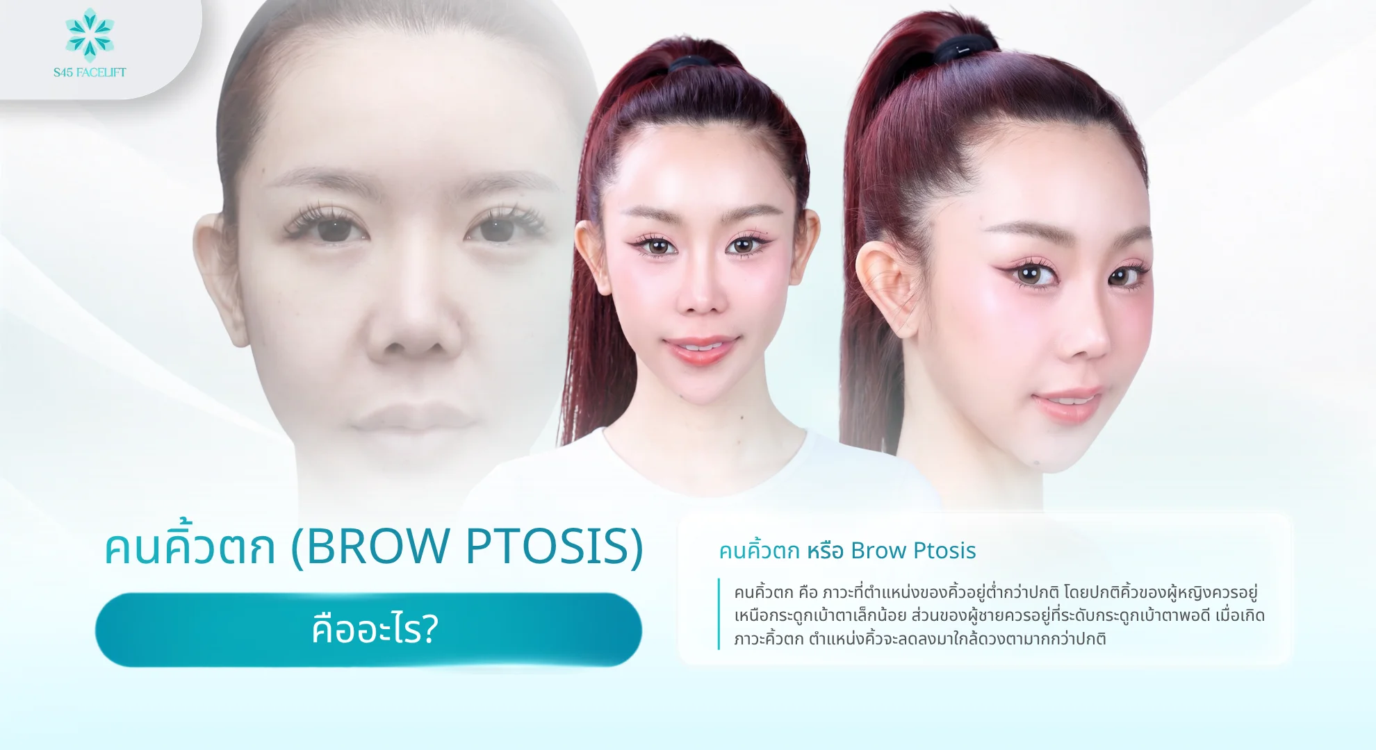 คนคิ้วตก สาเหตุ ผลกระทบ และวิธีแก้ครบทั้งไม่ผ่าตัดและผ่าตัด