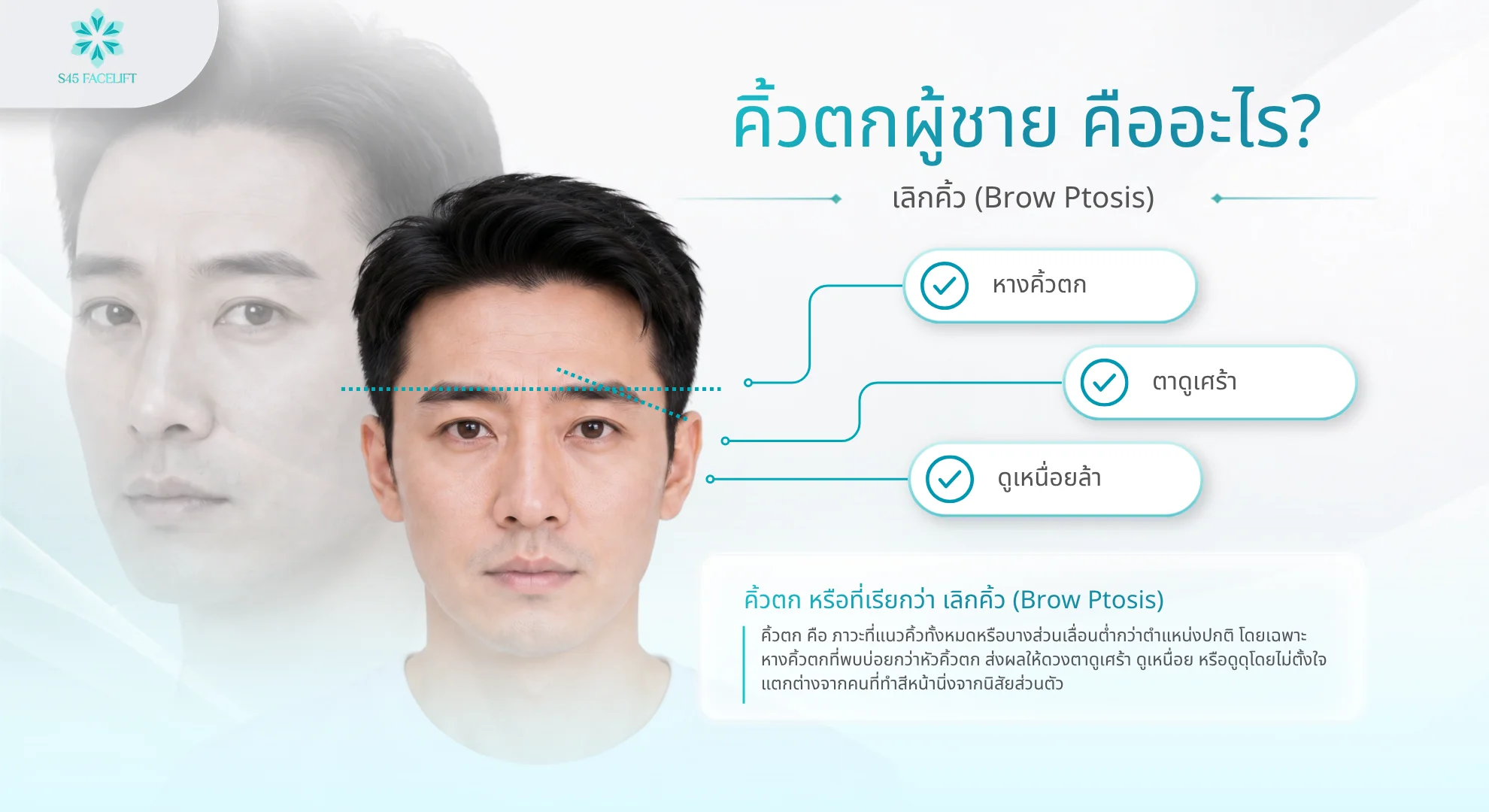 คิ้วตก ผู้ชาย คืออะไร สาเหตุและวิธีแก้คิ้วตกสำหรับผู้ชาย