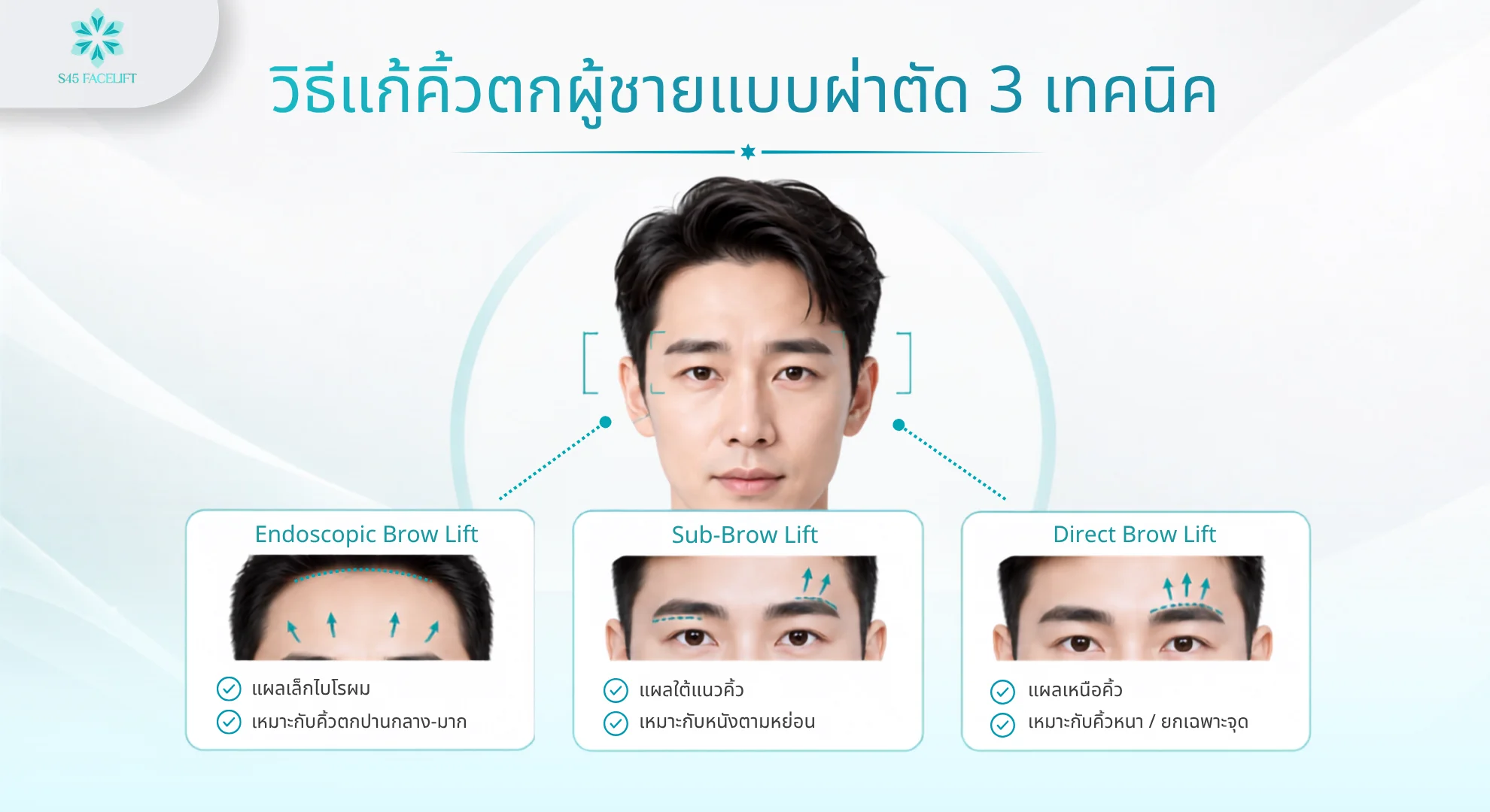 3 เทคนิคยกคิ้วผู้ชาย Endoscopic Brow Lift Sub-Brow Lift และ Direct Brow Lift